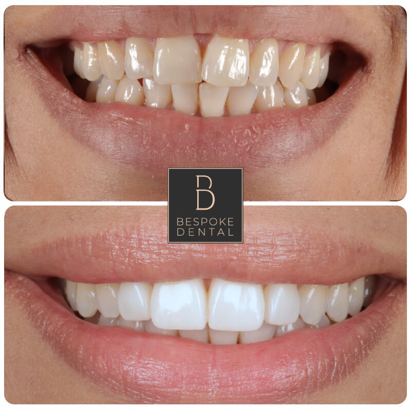 Smile Gallery Whitening and Composite veneers Reading